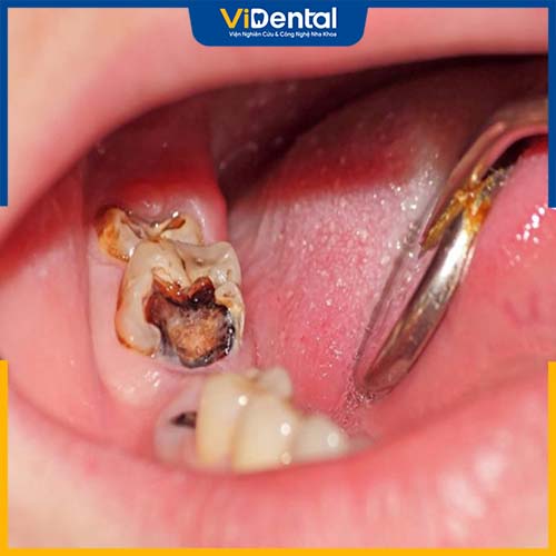 Trường hợp răng sâu nghiêm trọng cần trám răng lấy tủy