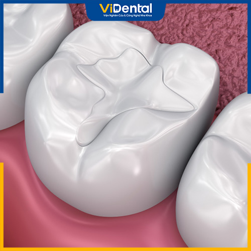 Trám răng Composite là phương pháp phục hình răng hiệu quả