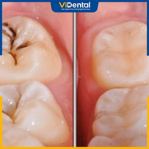Hình ảnh trước và sau khi thực hiện trám răng Composite