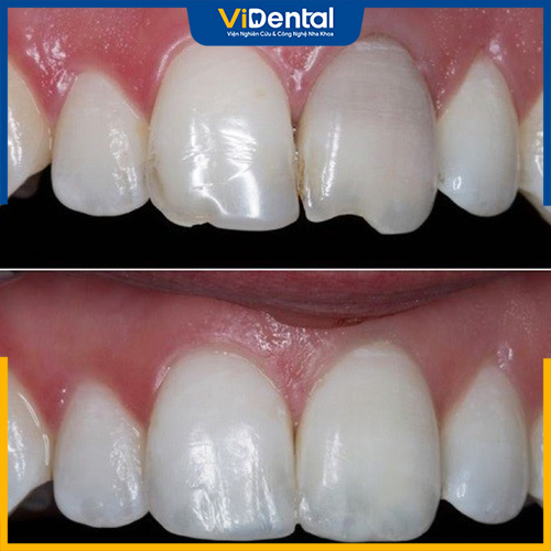 Trám răng Composite mang lại hiệu quả phục hình răng cao