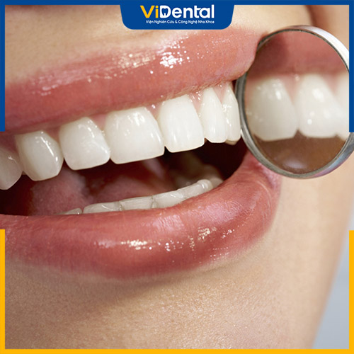 Trám răng cửa bị mẻ có đau không là thắc mắc chung của khách hàng