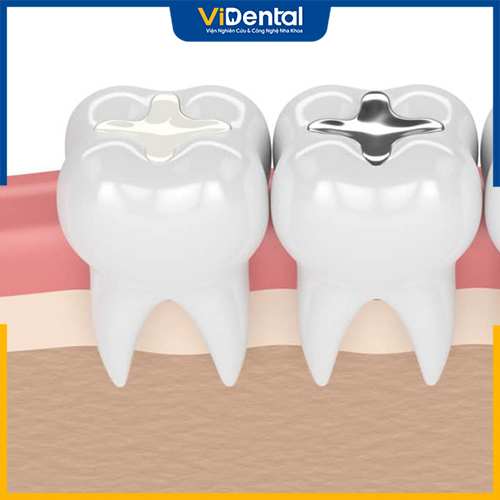 Có nhiều loại vật liệu trám răng khác nhau