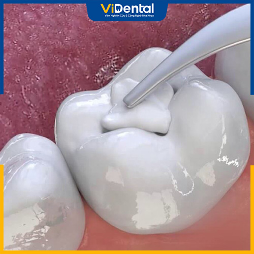 Quy trình trám răng cần được thực hiện đúng chuẩn, đảm bảo an toàn