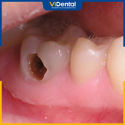 Răng sâu lỗ to xuất hiện khi bệnh sâu răng lâu ngày không được xử lý