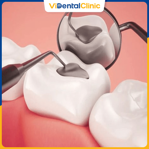Trám răng sứ là kỹ thuật chỉnh nha phục hồi tình trạng răng khá đơn giản