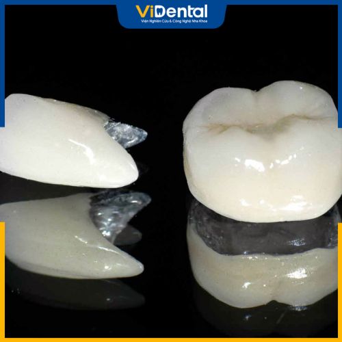Răng sứ kim loại đang là sản phẩm truyền thống và áp dụng phổ biến