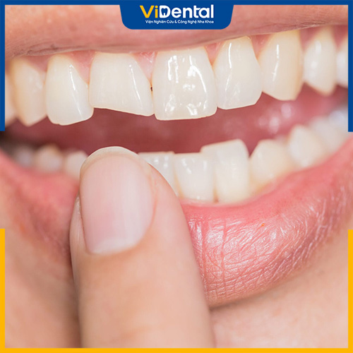 Bọc răng cửa bị mẻ là giải pháp hiệu quả tối ưu khi răng mẻ vỡ