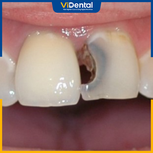 Bọc răng cửa bị sâu là phương pháp khắc phục răng sâu an toàn