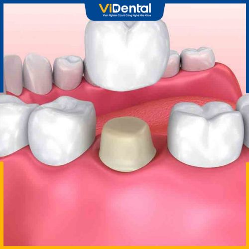 Lưu ý chăm sóc răng hàm sau khi bọc sứ