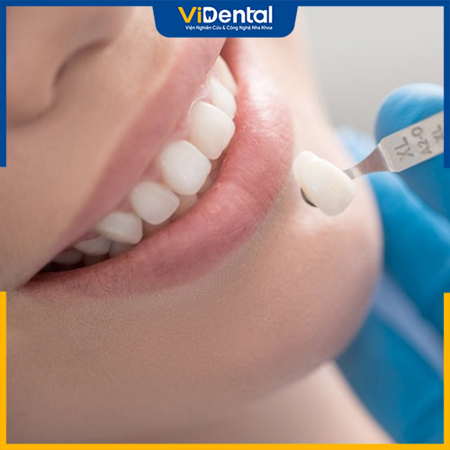 Chọn răng toàn sứ để bọc sứ 16 răng có nhiều ưu điểm