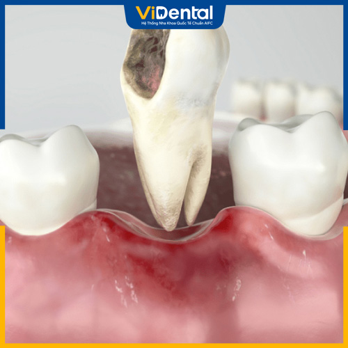Sâu răng cũng là một trong những hậu quả bọc răng sứ bạn cần chú ý