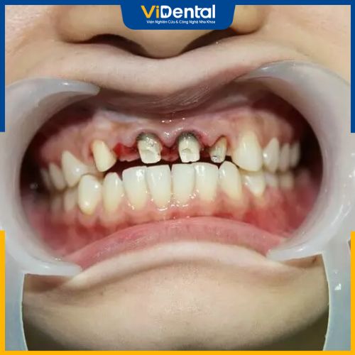 Hỏng răng thật là biến chứng nguy hiểm nhất khi bọc răng sứ