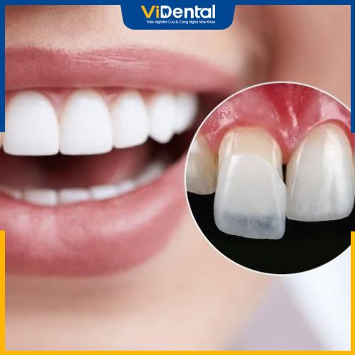 Miếng dán răng thưa sẽ phủ một lớp mỏng sứ (khoảng 0.3 - 0.5mm) lên răng