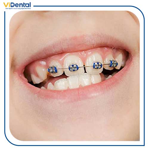 Niềng 2 răng là phương pháp rất hiếm khi được áp dụng trong quá trình chỉnh nha