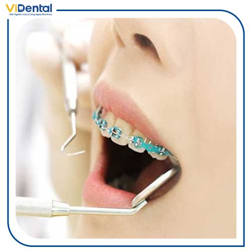 Niềng hai răng cửa bị hô tùy thuộc vào tình trạng răng miệng của bệnh nhân
