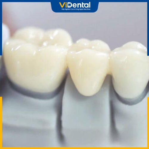 Mão răng chất lượng kém cũng có thể gây nhiều hệ lụy nguy hại