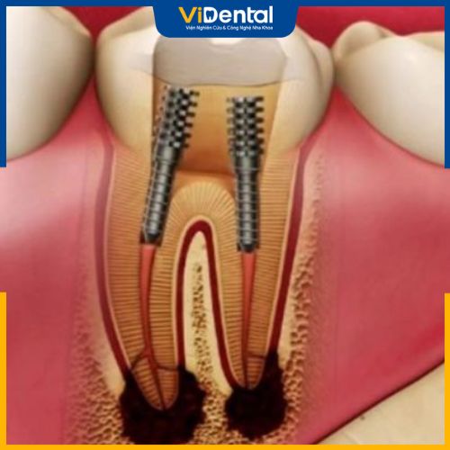 Biện pháp phòng ngừa tình trạng viêm tủy của răng bọc sứ