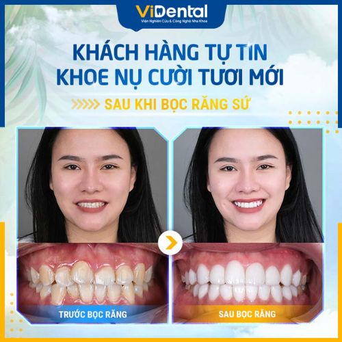 Khách hàng phản hồi dịch vụ bọc răng sứ tại ViDental Clinic