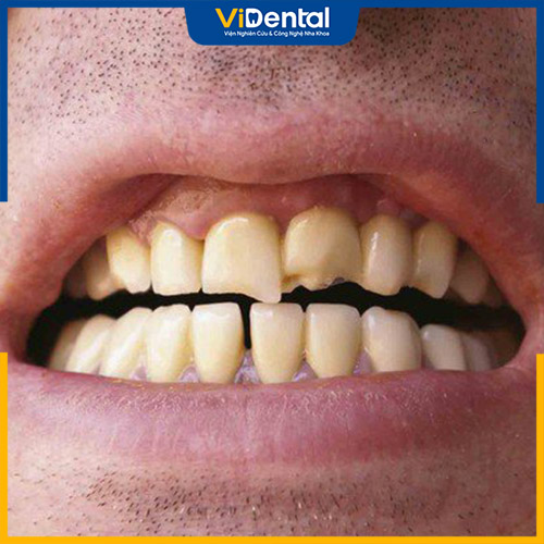 Bọc răng sứ là biện pháp cần thiết khi răng bị sứt mẻ, hư tổn