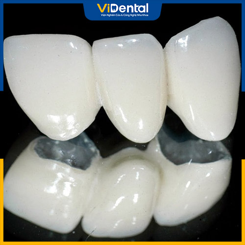 Răng sứ kim loại là lựa chọn của nhiều khách hàng khi làm răng sứ