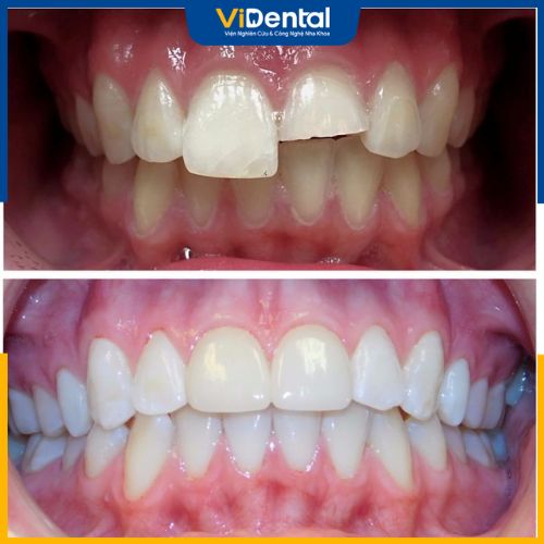 Bọc răng sứ nguyên hàm được áp dụng cho các trường hợp bị hư hỏng nhiều răng