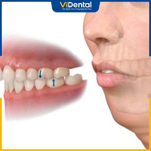 Niềng răng invisalign phù hợp với các trường hợp bị hô, vẩu