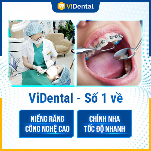 ViDental Clinic là địa chỉ niềng răng trả góp tại TP HCM được nhiều người biết đến 
