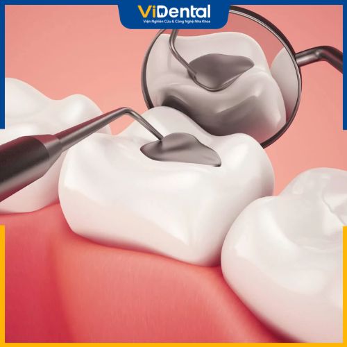 Trám răng sau bao lâu thì cần trám lại phụ thuộc vào vật liệu trám