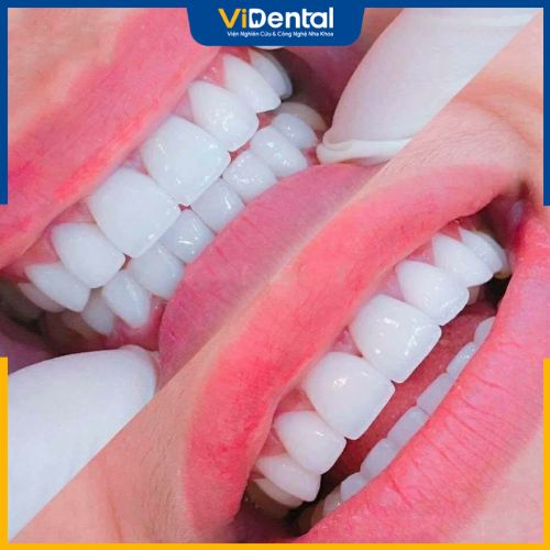 Phương pháp bọc răng sứ cho răng cửa được xem là giải pháp tối ưu hơn cả
