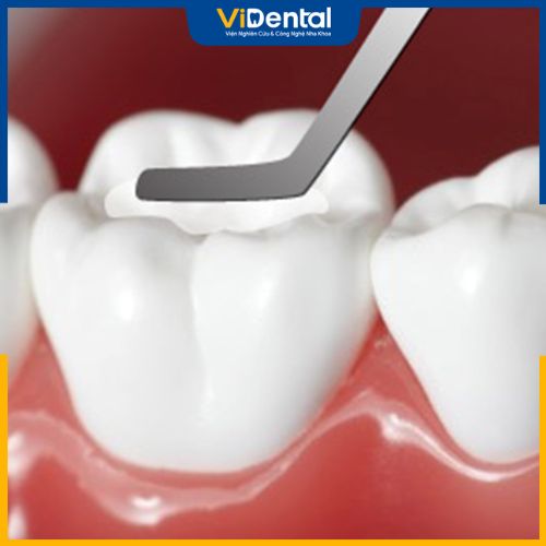 Trám răng sâu là thủ thuật nha khoa phổ biến được áp dụng trong điều trị sâu răng