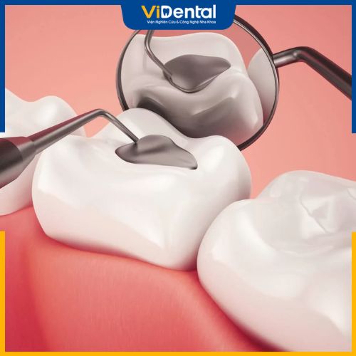 Trám răng là phương pháp an toàn, phù hợp với hầu hết bệnh nhân sâu răng