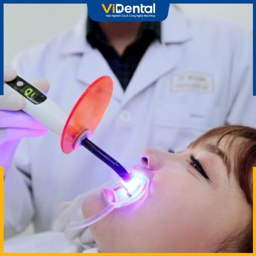 Công nghệ trám răng hiện đại 4.0 Laser Tech