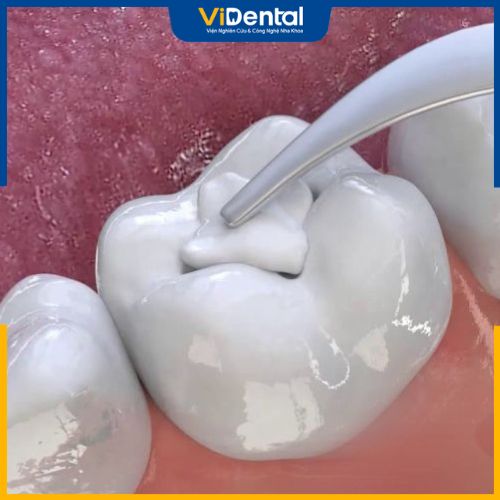 Thực hiện trám răng tại Trung Tâm ViDental Clinic bạn sẽ được hưởng chính sách thanh toán linh hoạt, hậu mãi hấp dẫn