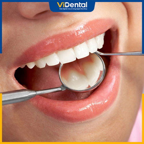 Cần lưu ý điều gì khi thực hiện trám răng sâu?