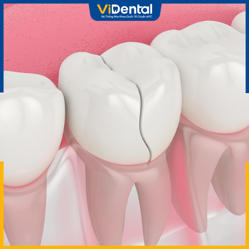 Răng sứ có thể nứt vỡ nếu bác sĩ thực hiện sai kỹ thuật