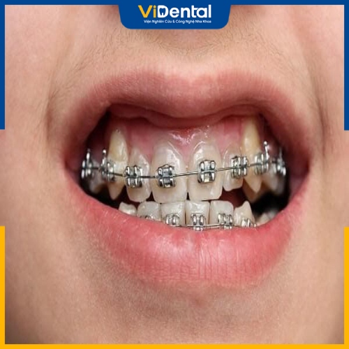 Niềng răng là giải pháp hữu hiệu cho tình trạng móm do răng