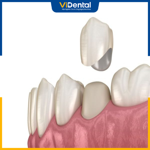 Bọc răng sứ giúp cải thiện tình trạng móm răng nhẹ