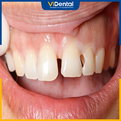 Răng bị mẻ, vỡ hoặc hỏng gây nên các khoảng trông trong cung hàm