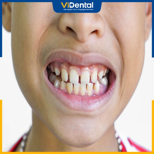 Nhiều thói quen xấu có thể gây nên việc răng bị thưa