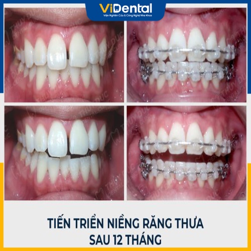 Niềng răng thưa cần 1 - 2 năm, chi phì tùy thuộc loại mắc cài hoặc khay niềng