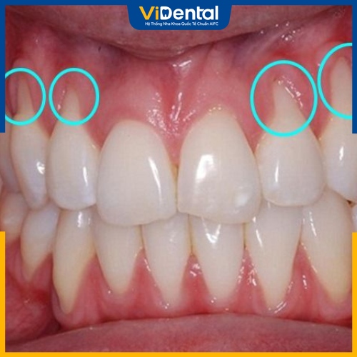 Tụt nướu răng sứ là dấu hiệu cho thấy bệnh nhân cần bọc lại 