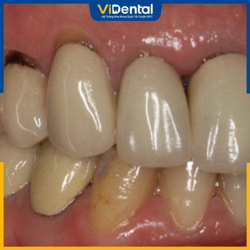 Bọc răng sứ kim loại thường kém chất lượng bị đen nướu