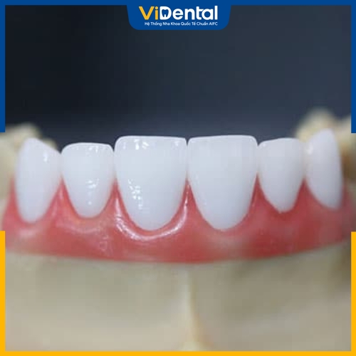 Cercon giúp khắc phục tình trạng bọc răng sứ bị đen nướu