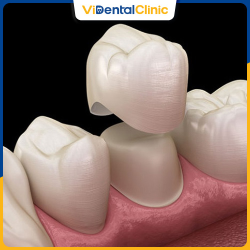 Răng hàm nên bọc loại cứng chắc để đảm bảo chức năng ăn nhai