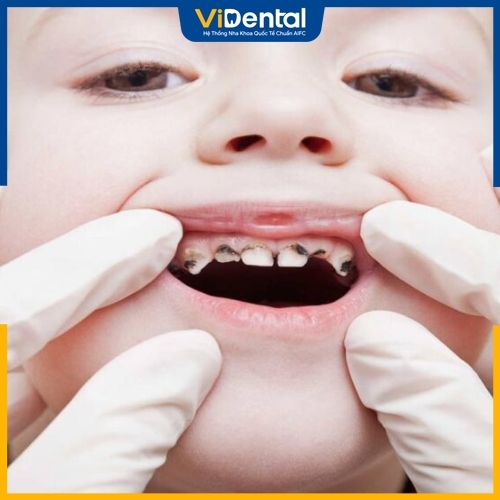 Sâu răng là nguyên nhân chính khiến trẻ phải bọc răng thép