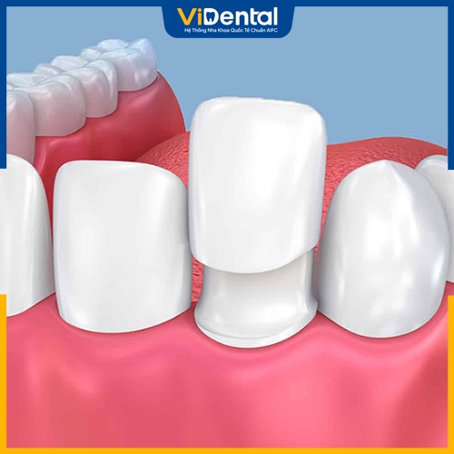 Gắn răng tạm sau khi mài răng giúp bảo vệ cùi răng thật 
