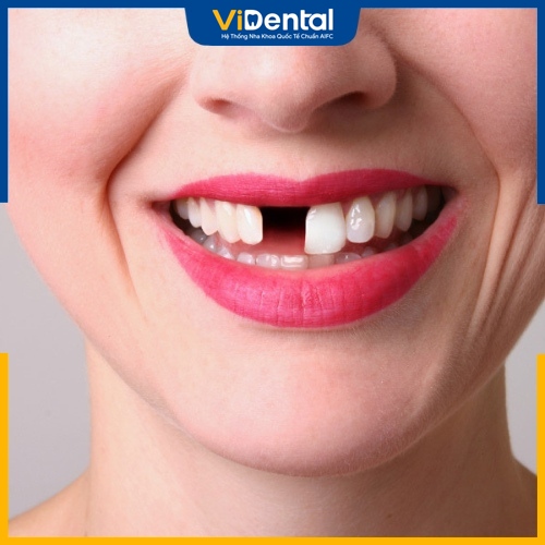 Gãy răng xuất phát từ nhiều nguyên nhân 