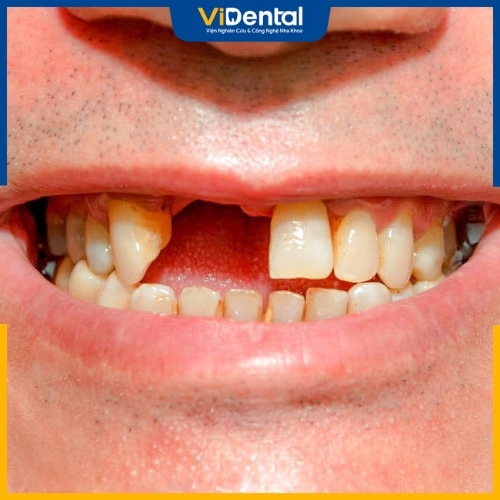Răng bị gãy làm suy giảm chức năng sinh lý 