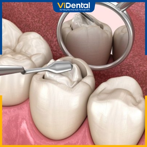 Trám răng được dùng để khắc phục gãy răng nhẹ 
