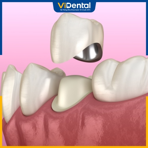 Bọc sứ là giải pháp hiệu quả cho tình trạng gãy răng ngang 